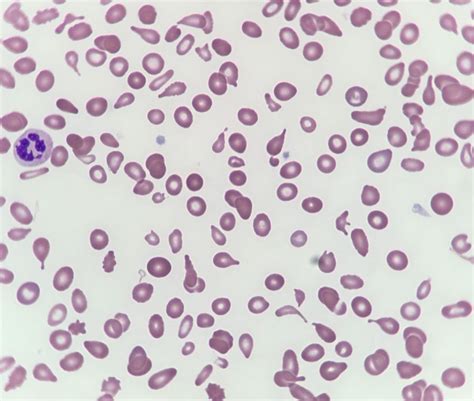 Dacryocytes (teardrop cells) .